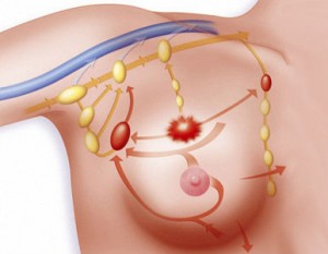 Cáncer de mama.